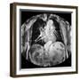 Dissecting Aorta, MRI Scan-Du Cane Medical-Framed Photographic Print