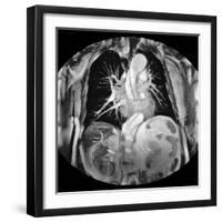 Dissecting Aorta, MRI Scan-Du Cane Medical-Framed Photographic Print