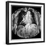 Dissecting Aorta, MRI Scan-Du Cane Medical-Framed Photographic Print