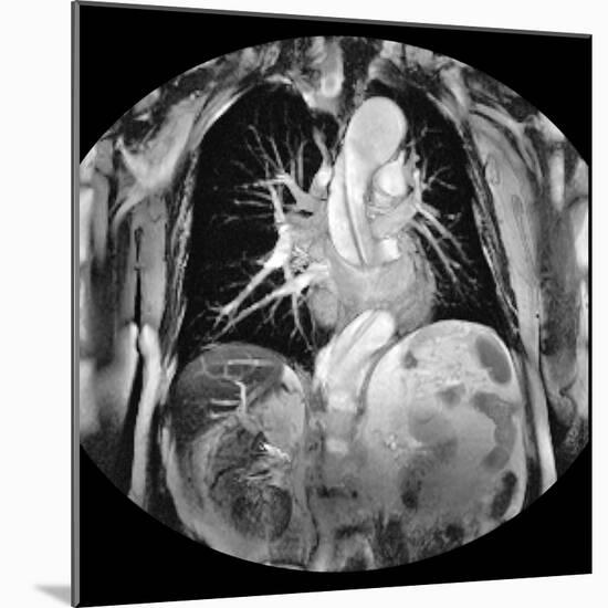 Dissecting Aorta, MRI Scan-Du Cane Medical-Mounted Photographic Print