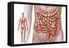 Diverticulitis in the Descending Colon Region of the Human Intestine-null-Framed Stretched Canvas