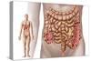 Diverticulitis in the Descending Colon Region of the Human Intestine-null-Stretched Canvas