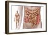 Diverticulitis in the Descending Colon Region of the Human Intestine-null-Framed Art Print