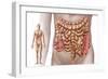 Diverticulitis in the Descending Colon Region of the Human Intestine-null-Framed Art Print