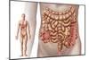 Diverticulitis in the Descending Colon Region of the Human Intestine-null-Mounted Art Print