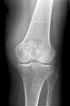 Fractured Kneecap, X-ray-Du Cane Medical-Photographic Print