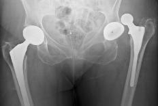 Arthritic Knee, X-ray-Du Cane Medical-Photographic Print