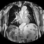 Dissecting Aorta, MRI Scan-Du Cane Medical-Photographic Print