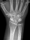 Fractured Wrist, X-ray-Du Cane Medical-Photographic Print