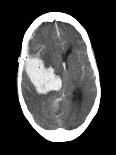 Subarachnoid Haemorrhage, MRI Scan-Du Cane Medical-Photographic Print