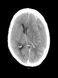 Subdural Haemorrhage, MRI Scan-Du Cane Medical-Photographic Print