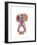 Early Stage of Kidney Cancer with a Tumor Visible on the Kidney-null-Framed Art Print
