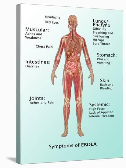 Ebola Virus Symptoms in Human, Illustration-Gwen Shockey-Stretched Canvas