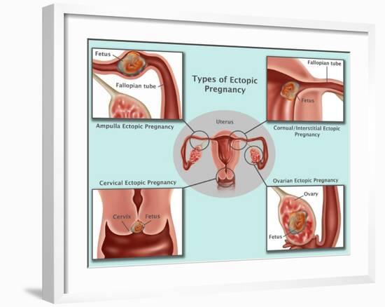 Ectopic Pregnancy-Gwen Shockey-Framed Giclee Print