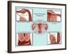 Ectopic Pregnancy-Gwen Shockey-Framed Giclee Print