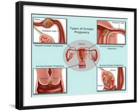 Ectopic Pregnancy-Gwen Shockey-Framed Giclee Print