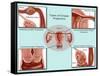 Ectopic Pregnancy-Gwen Shockey-Framed Stretched Canvas