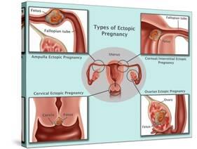 Ectopic Pregnancy-Gwen Shockey-Stretched Canvas