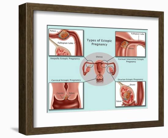 Ectopic Pregnancy-Gwen Shockey-Framed Giclee Print