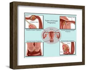 Ectopic Pregnancy-Gwen Shockey-Framed Giclee Print