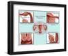 Ectopic Pregnancy-Gwen Shockey-Framed Giclee Print