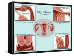 Ectopic Pregnancy-Gwen Shockey-Framed Stretched Canvas