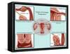 Ectopic Pregnancy-Gwen Shockey-Framed Stretched Canvas