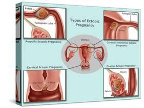 Ectopic Pregnancy-Gwen Shockey-Stretched Canvas