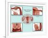 Ectopic Pregnancy-Gwen Shockey-Framed Giclee Print