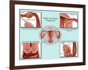 Ectopic Pregnancy-Gwen Shockey-Framed Giclee Print