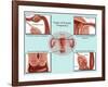 Ectopic Pregnancy-Gwen Shockey-Framed Giclee Print