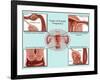 Ectopic Pregnancy-Gwen Shockey-Framed Giclee Print