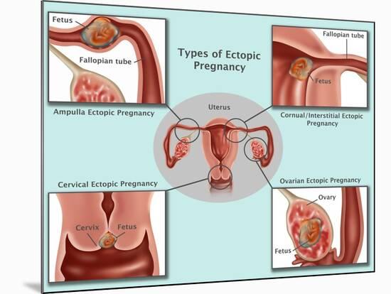 Ectopic Pregnancy-Gwen Shockey-Mounted Giclee Print