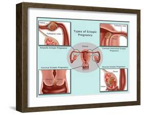 Ectopic Pregnancy-Gwen Shockey-Framed Giclee Print