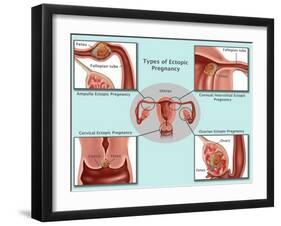 Ectopic Pregnancy-Gwen Shockey-Framed Giclee Print