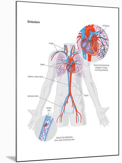 Embolism-Encyclopaedia Britannica-Mounted Poster