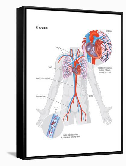 Embolism-Encyclopaedia Britannica-Framed Stretched Canvas