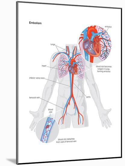 Embolism-Encyclopaedia Britannica-Mounted Poster