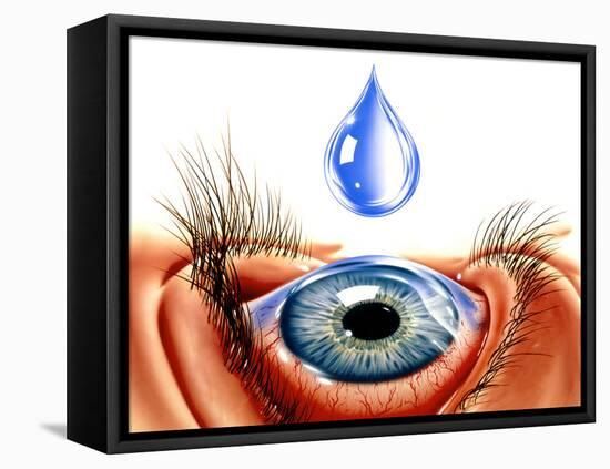 Eye with Conjunctivitis-John Bavosi-Framed Stretched Canvas