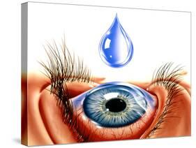 Eye with Conjunctivitis-John Bavosi-Stretched Canvas