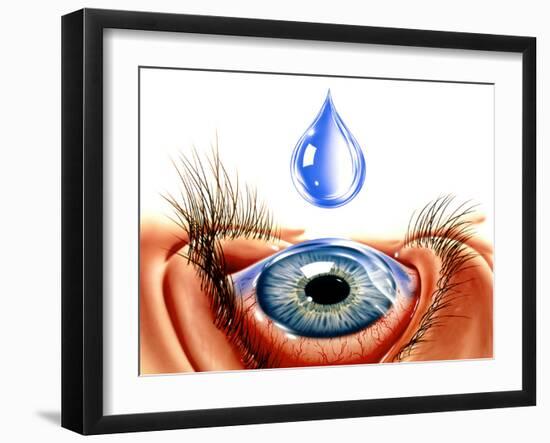 Eye with Conjunctivitis-John Bavosi-Framed Photographic Print