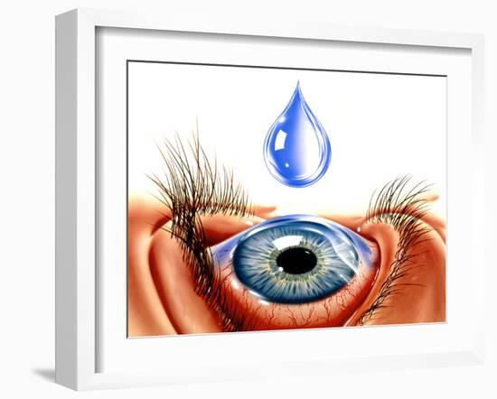 Eye with Conjunctivitis-John Bavosi-Framed Photographic Print