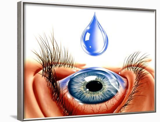 Eye with Conjunctivitis-John Bavosi-Framed Photographic Print