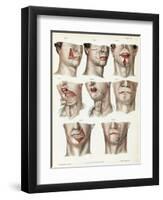 Facial Surgery, Illustration, 1846-Science Source-Framed Giclee Print