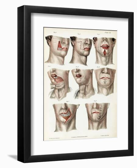 Facial Surgery, Illustration, 1846-Science Source-Framed Giclee Print