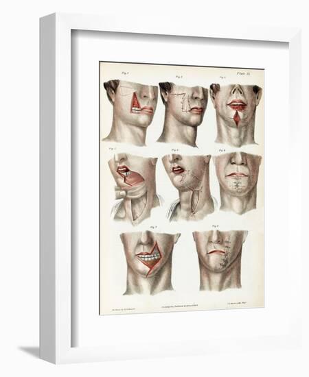 Facial Surgery, Illustration, 1846-Science Source-Framed Giclee Print