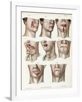 Facial Surgery, Illustration, 1846-Science Source-Framed Giclee Print