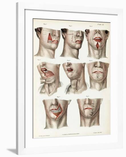 Facial Surgery, Illustration, 1846-Science Source-Framed Giclee Print