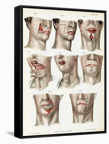 Facial Surgery, Illustration, 1846-Science Source-Framed Stretched Canvas