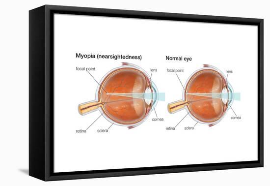 Farsighted Eye (Hyperopia). Convex Lens, Ophthalmology, Health and Disease-Encyclopaedia Britannica-Framed Stretched Canvas